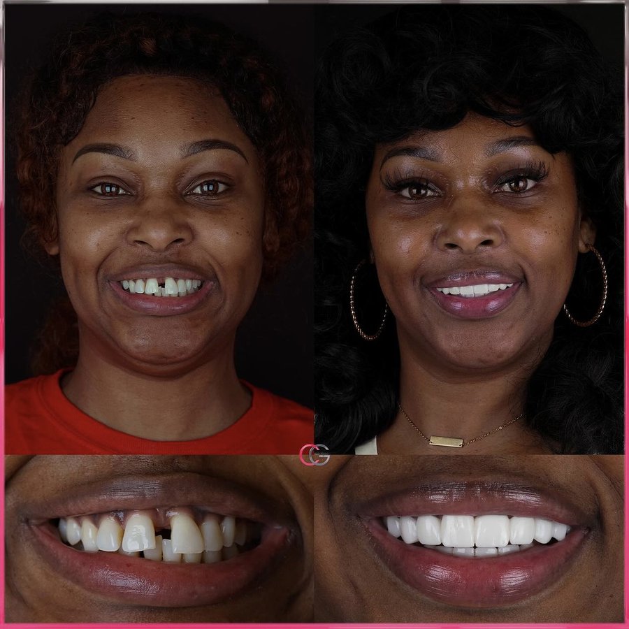 Smile design with Porcelain Veneers and Bridges