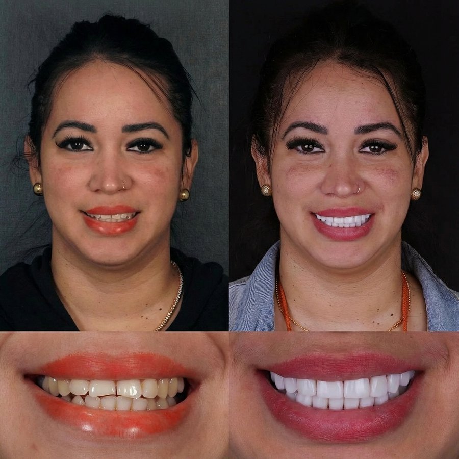 Smile design with Porcelain Veneers
