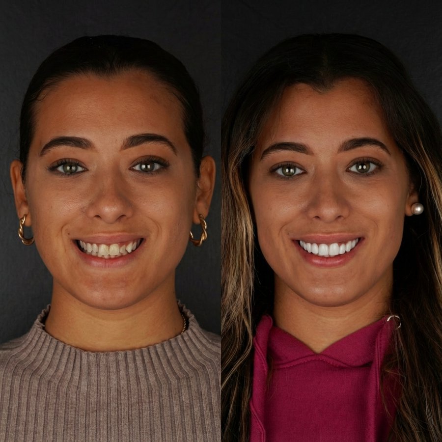 Smile design with Porcelain Veneers