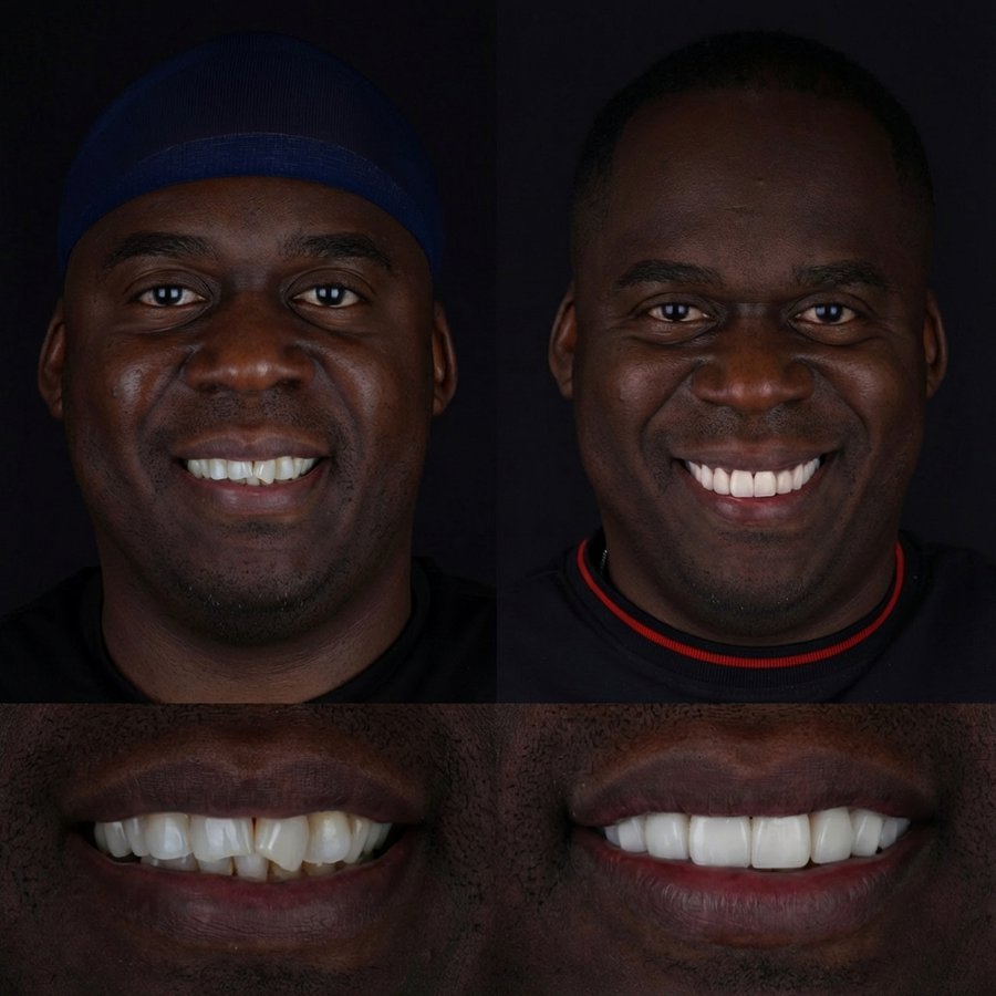 Smile design with Porcelain Veneers
