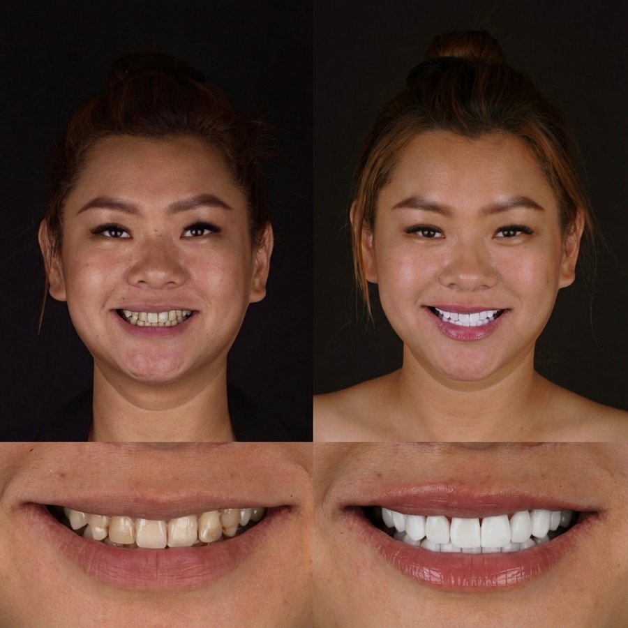 Smile design with Porcelain Veneers