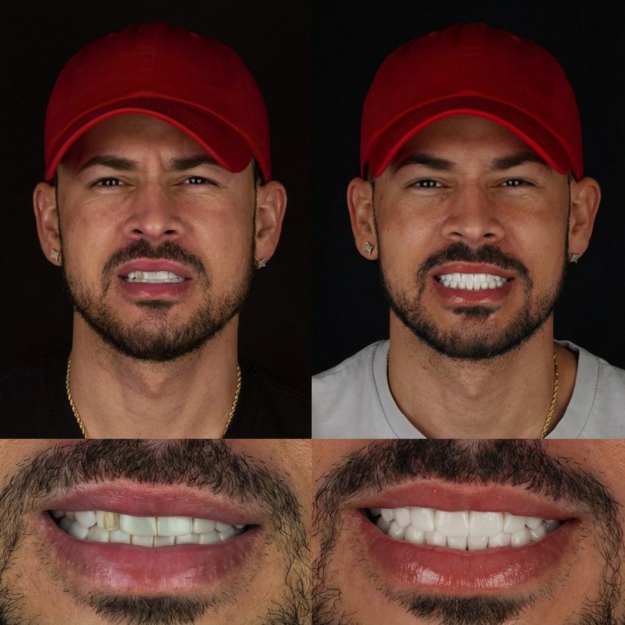 Smile design with Porcelain Veneers