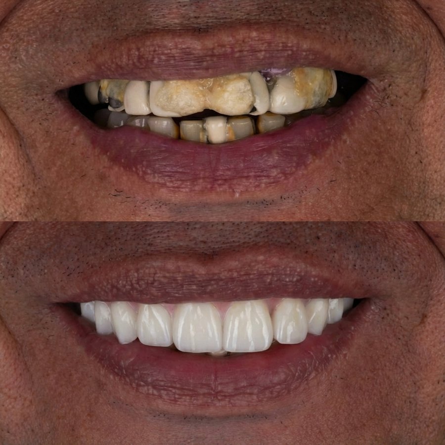 Hybrid Denture (top only)