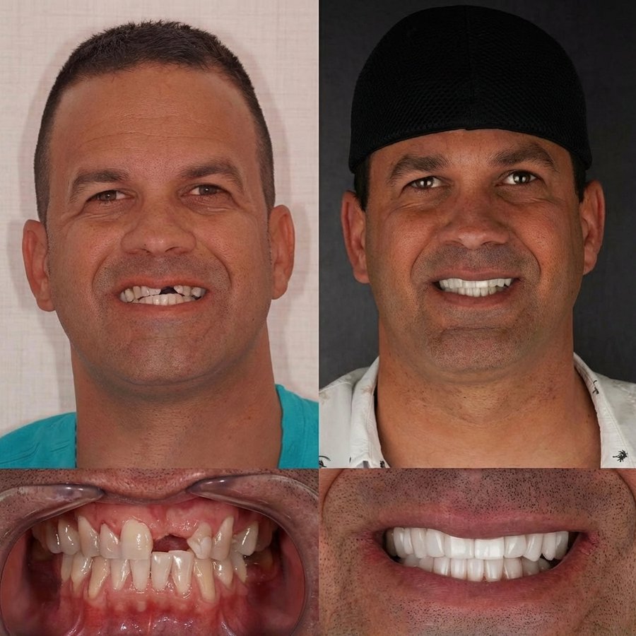 Smile design with Porcelain Veneers and Implant