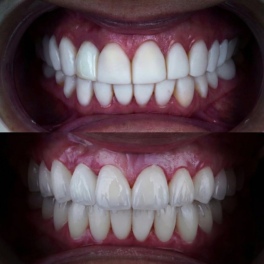 Smile design with Porcelain Veneers