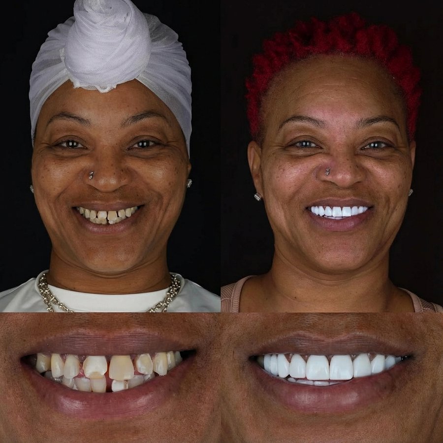 Smile design with Porcelain Veneers