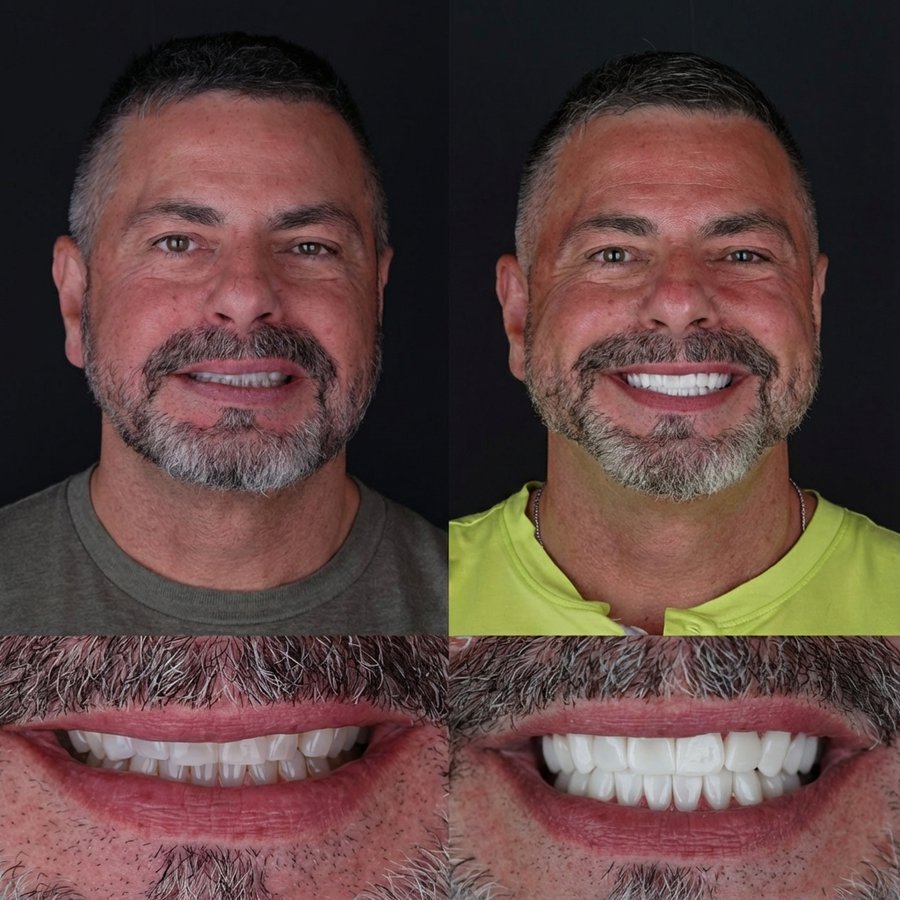 Smile design with Porcelain Veneers