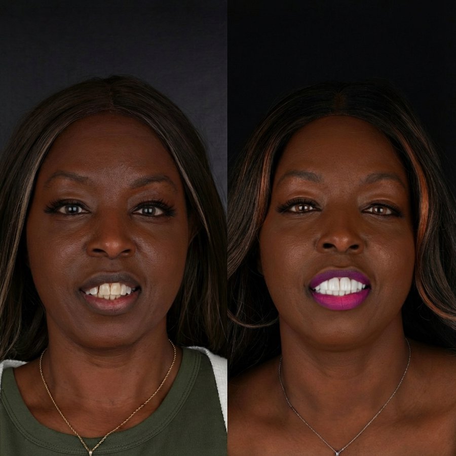 Smile design with Porcelain Veneers