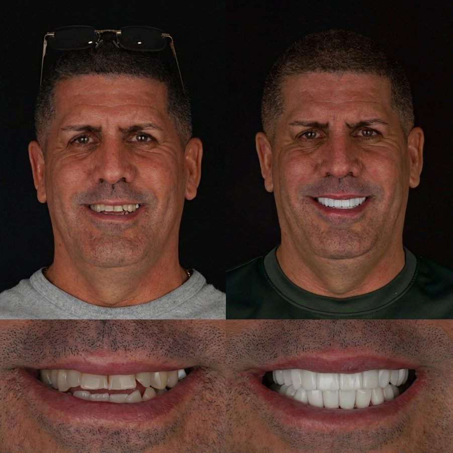 Smile design with Porcelain Veneers