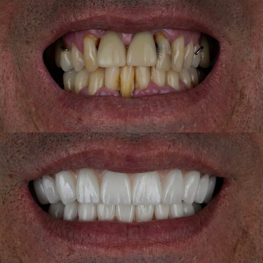 Hybrid Denture (top and bottom)