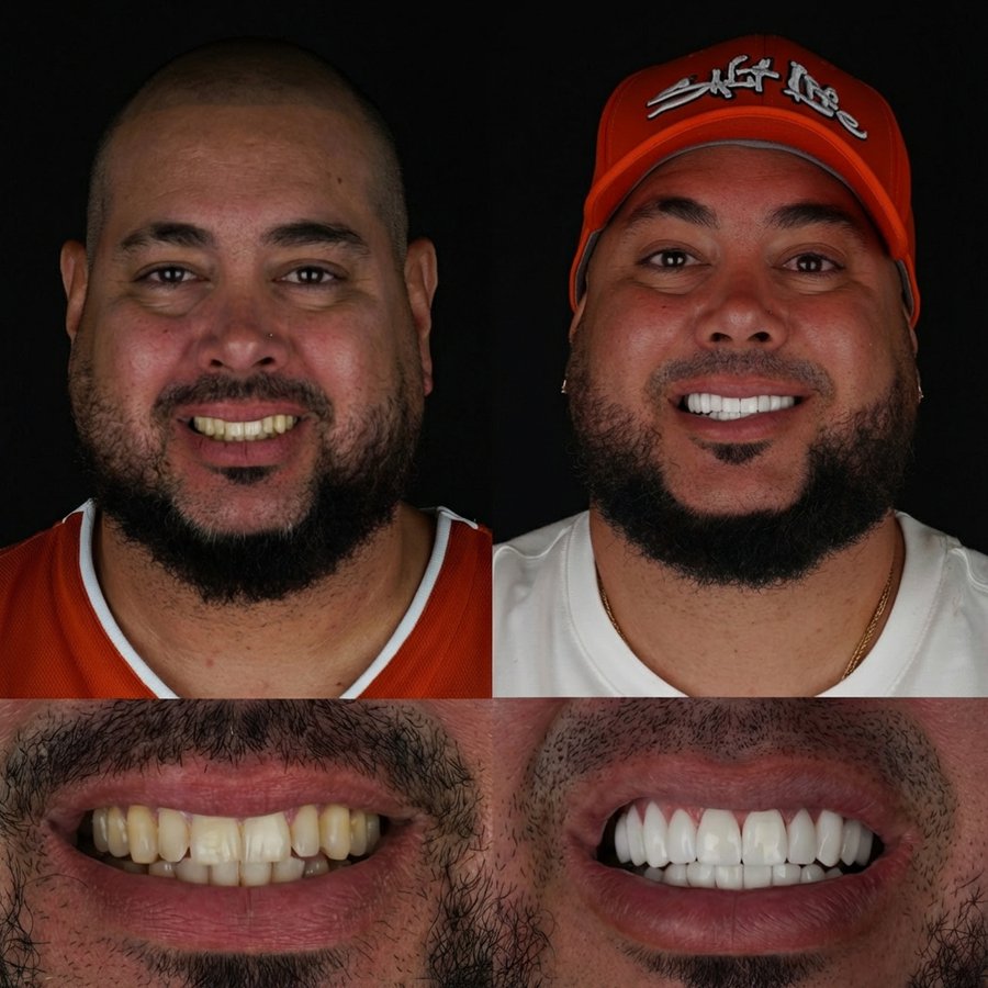 Smile design with Porcelain Veneers