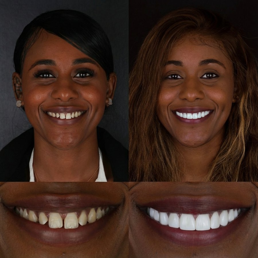Smile design with Porcelain Veneers