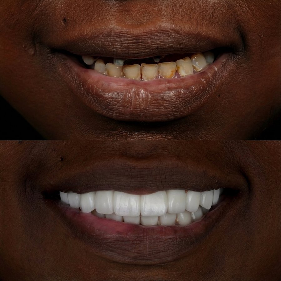 Hybrid Denture (top) Porcelain Veneers (bottom)