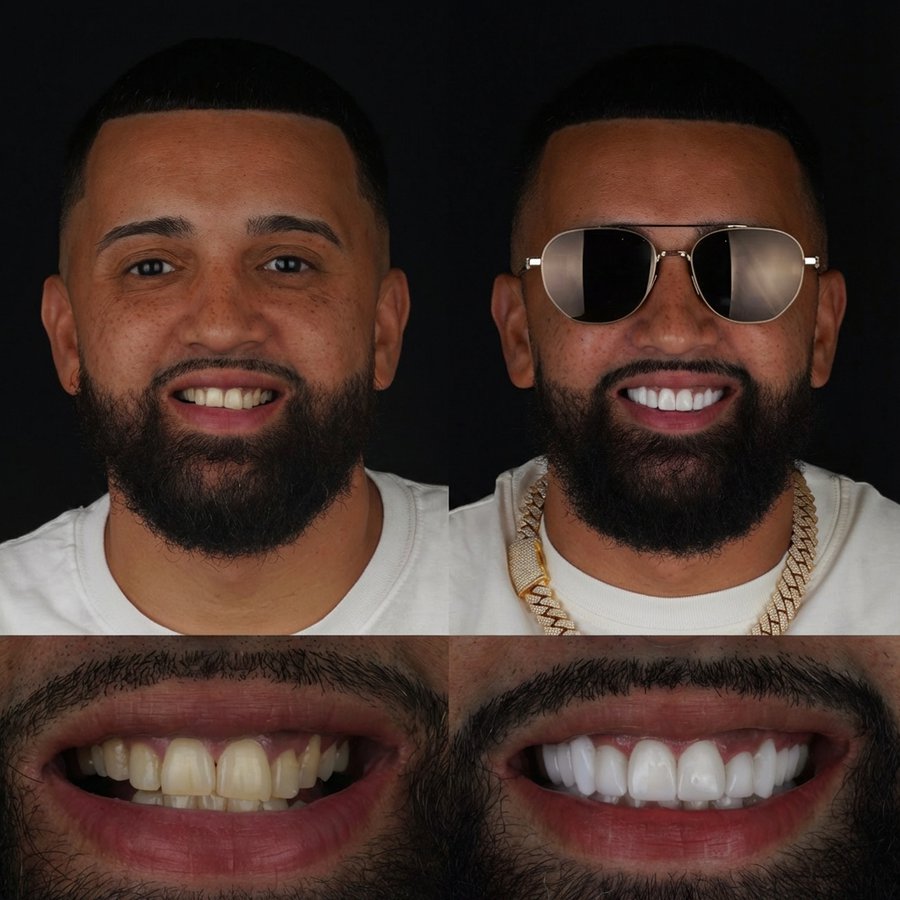 Smile design with Porcelain Veneers