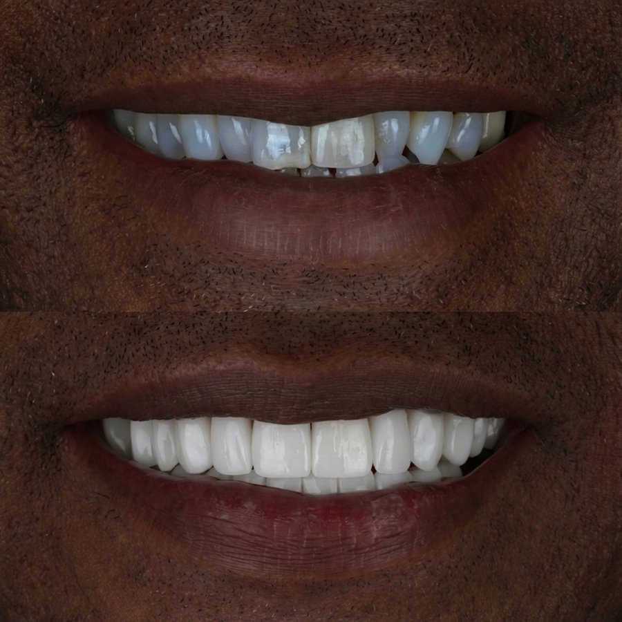 Smile design with Porcelain Veneers