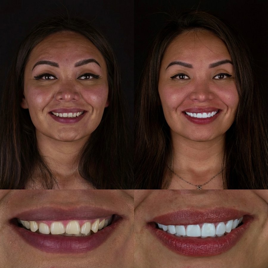 Smile design with Porcelain Veneers