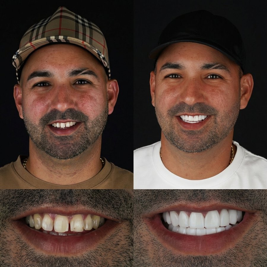 Smile design with Porcelain Veneers