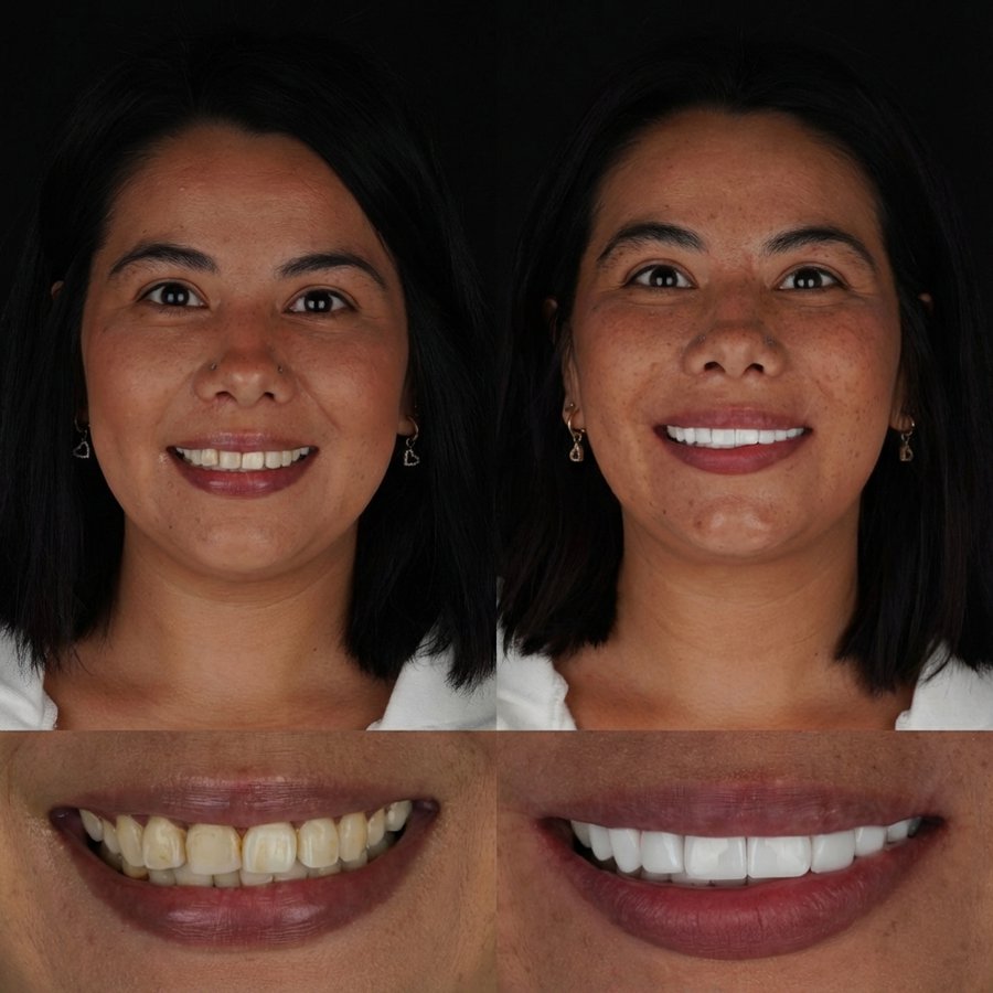 Smile design with Porcelain Veneers