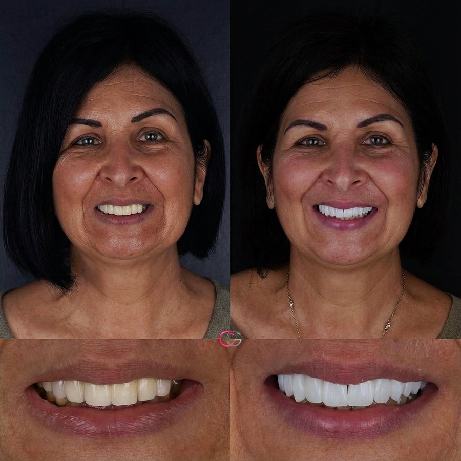 Smile design with Porcelain Veneers