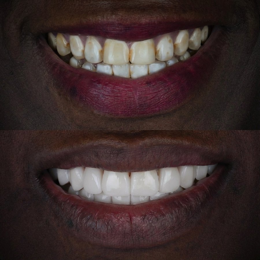 Smile design with Porcelain Veneers