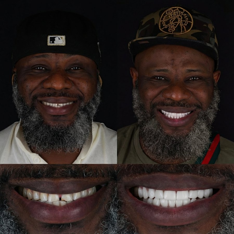 Smile design with Porcelain Veneers