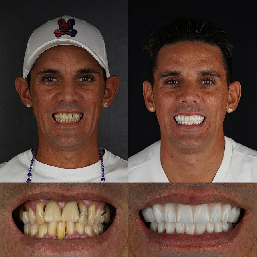 Hybrid Denture (top and bottom)