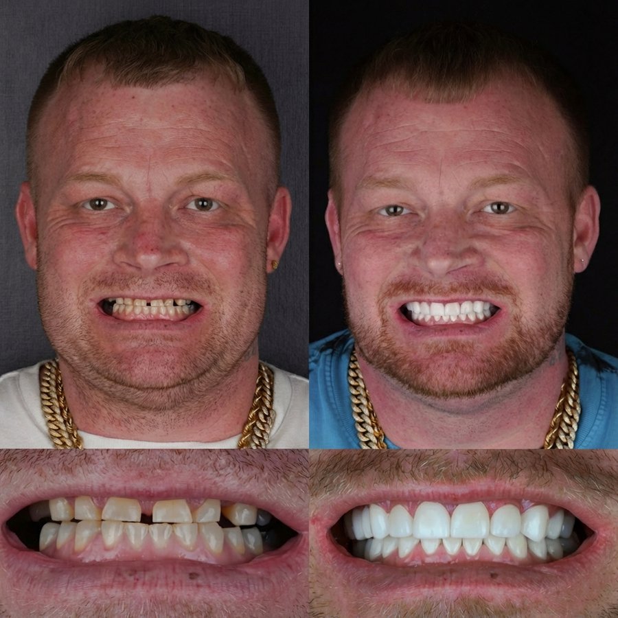 Smile design with Porcelain Veneers