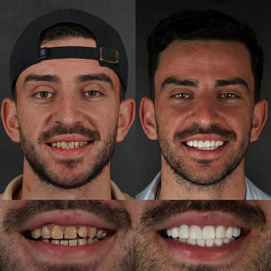 Smile design with Porcelain Veneers