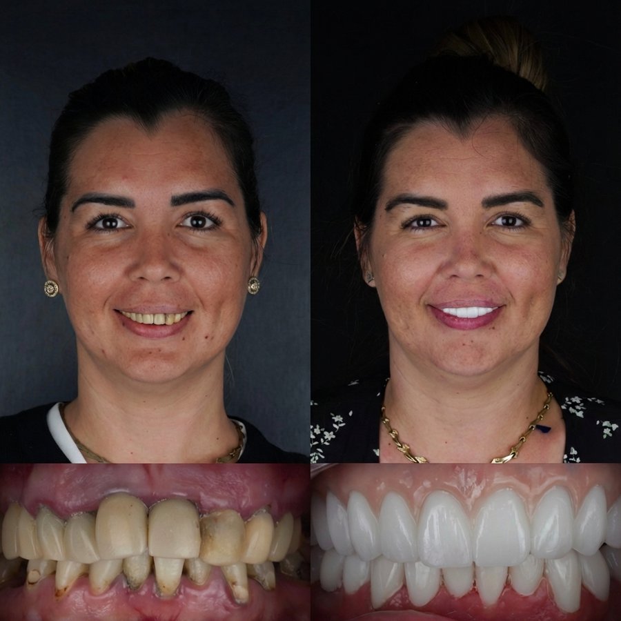 Hybrid Denture (top only) and porcelain Veneers (bottom)