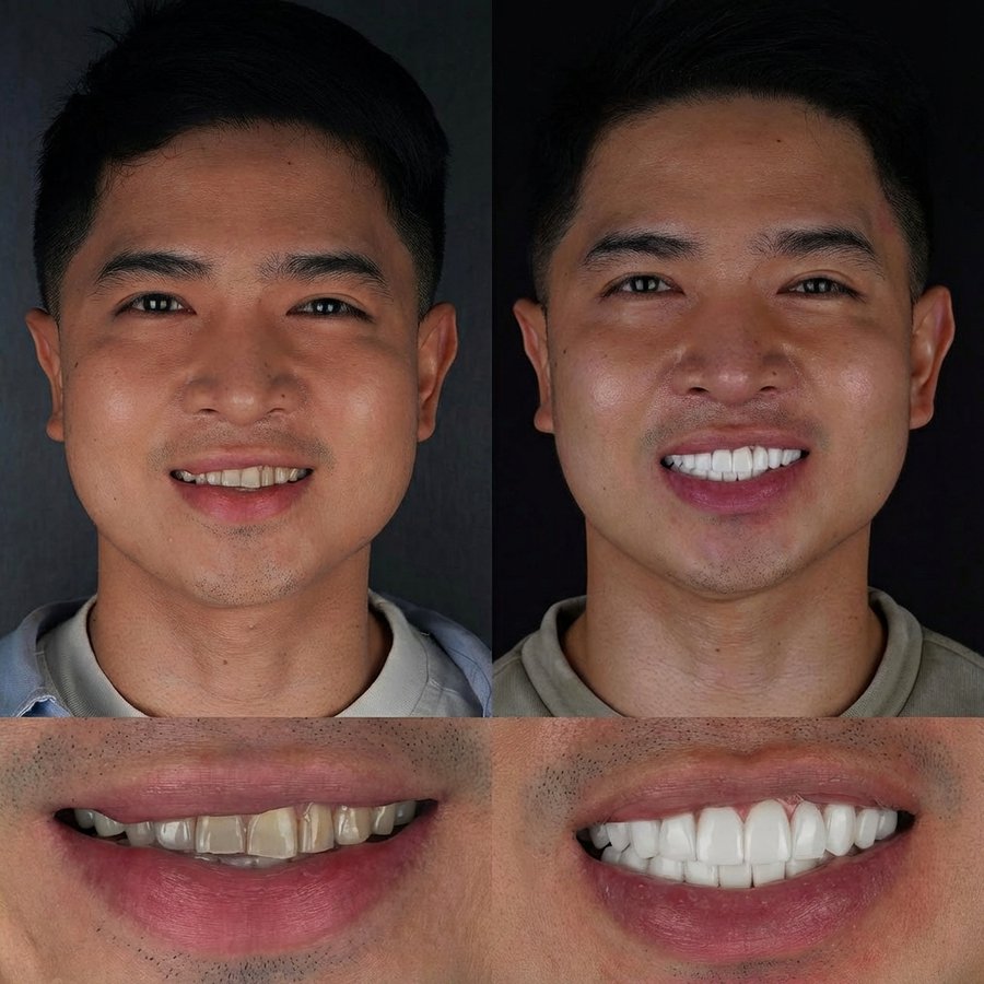 Smile design with Porcelain Veneers