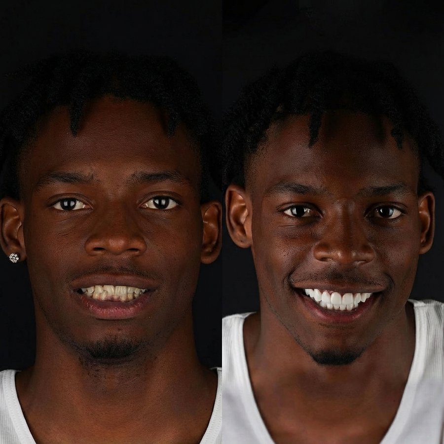 Smile design with Porcelain Veneers