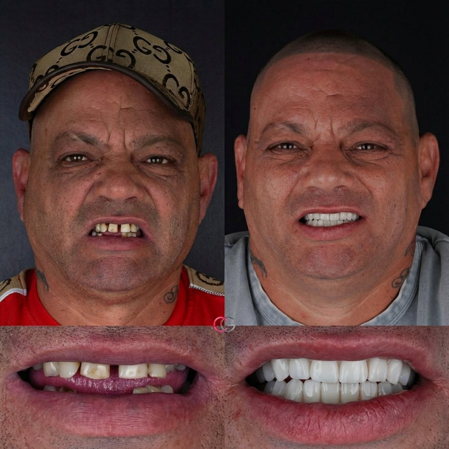 Smile design with Porcelain Veneers