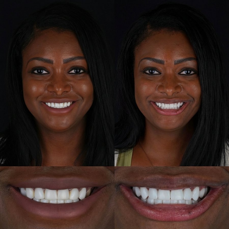 Smile design with Porcelain Veneers