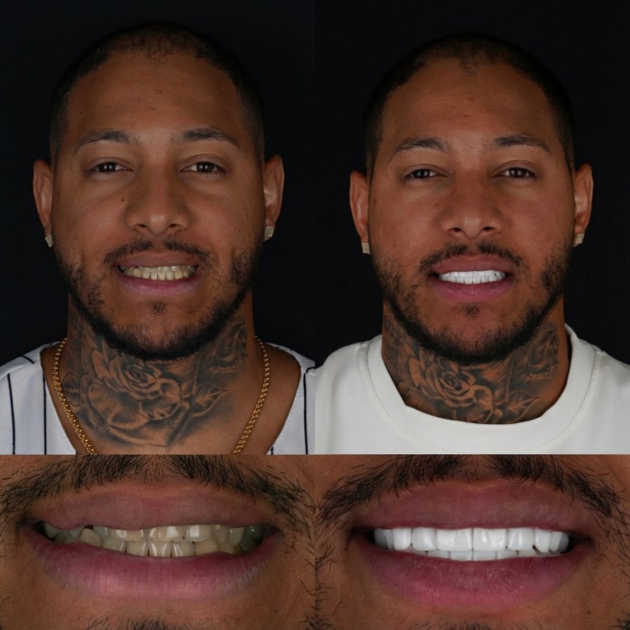 Smile design with Porcelain Veneers