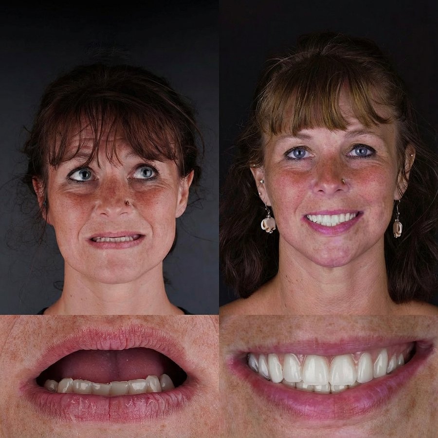 Hybrid Denture (top only)