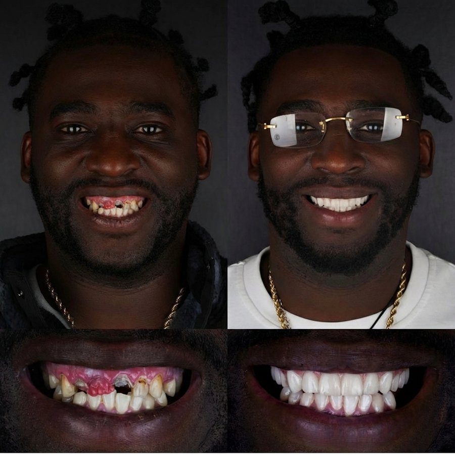 Hybrid Denture (top) Porelain Veneers (bottom)