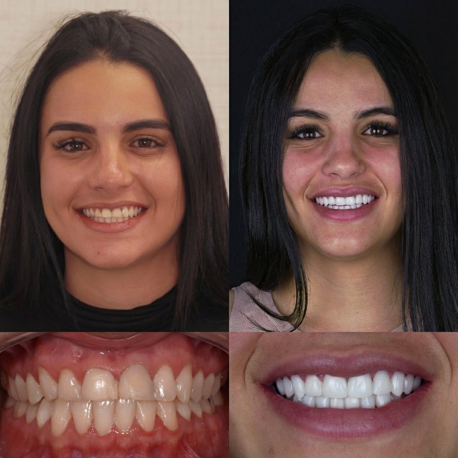 Smile design with Porcelain Veneers
