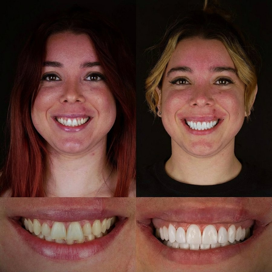 Smile design with Porcelain Veneers