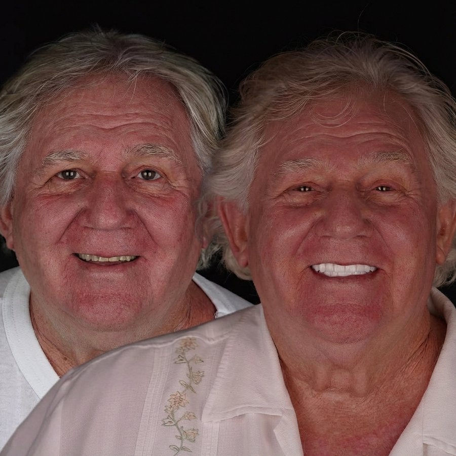 Hybrid Denture (top and bottom)