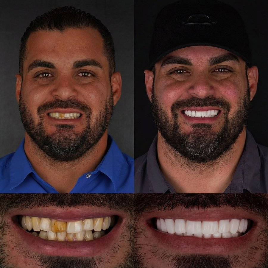 Smile design with Porcelain Veneers