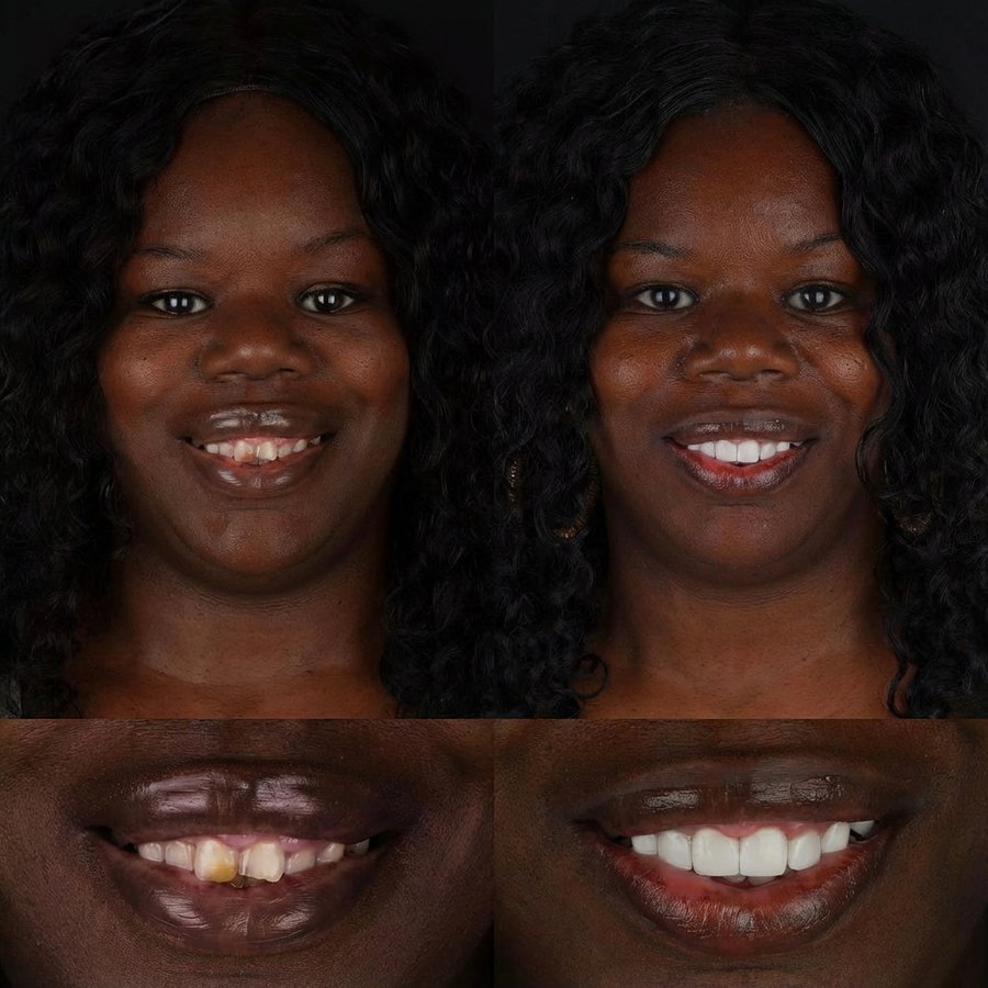 Smile design with Porcelain Veneers