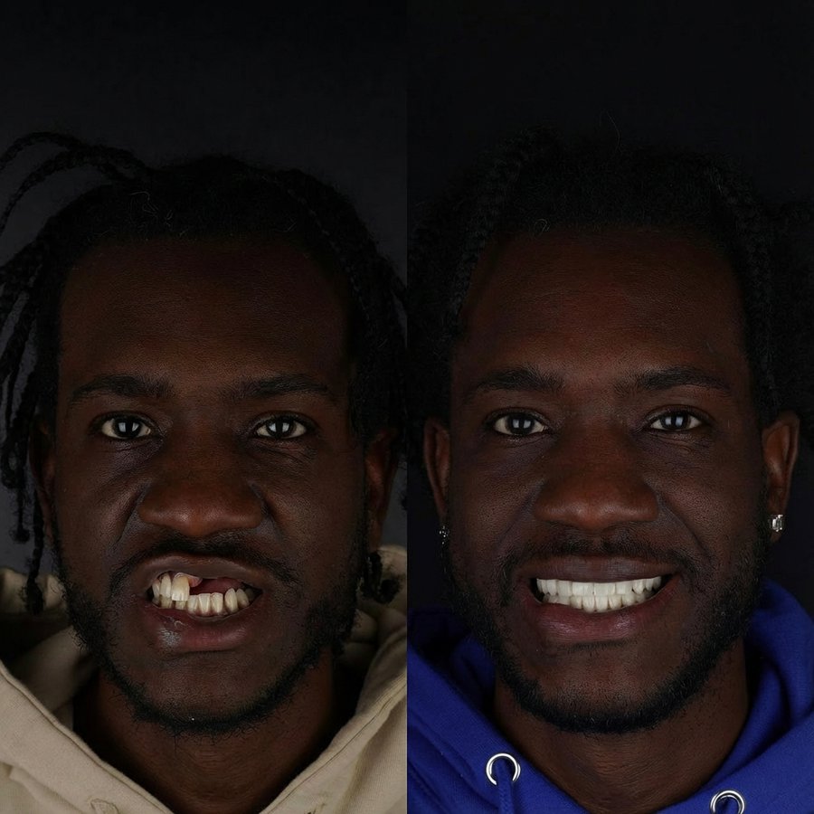 Hybrid Dentures (top) Porcelain Veneers (bottom)