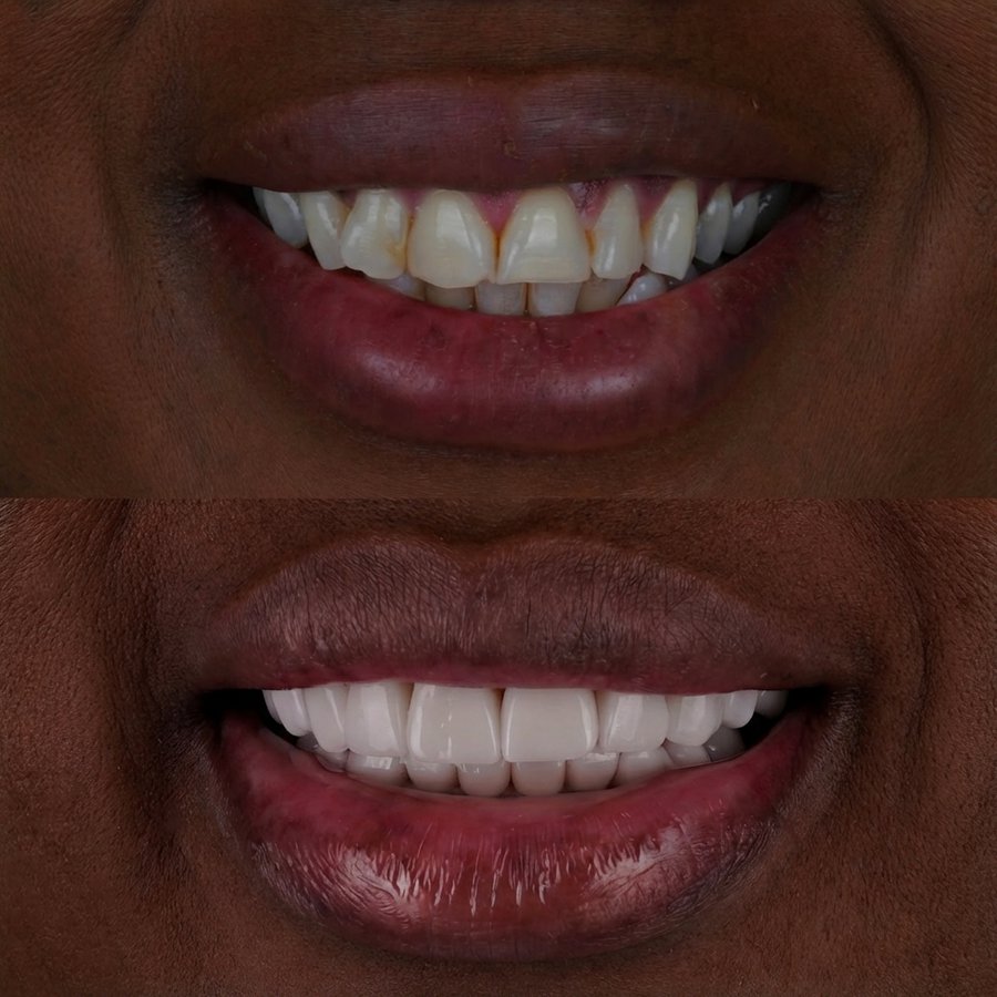 Smile design with Porcelain Veneers