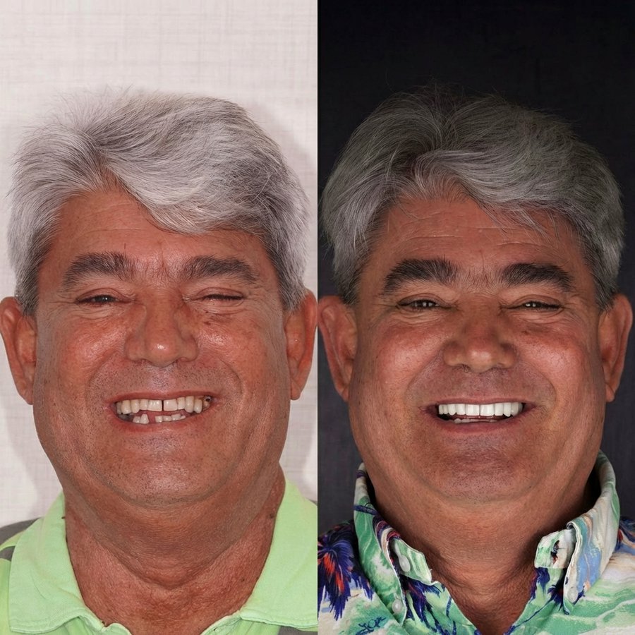 Hybrid Denture (bottom) and Porcelain Veneers (top)