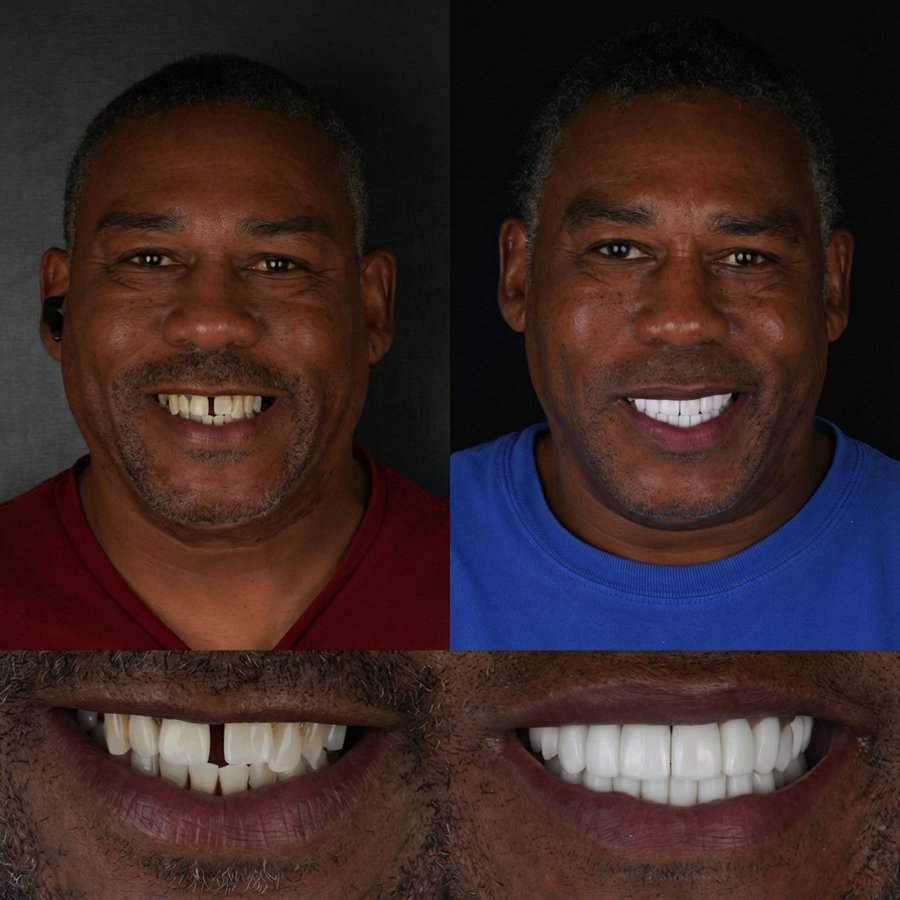 Smile design with Porcelain Veneers