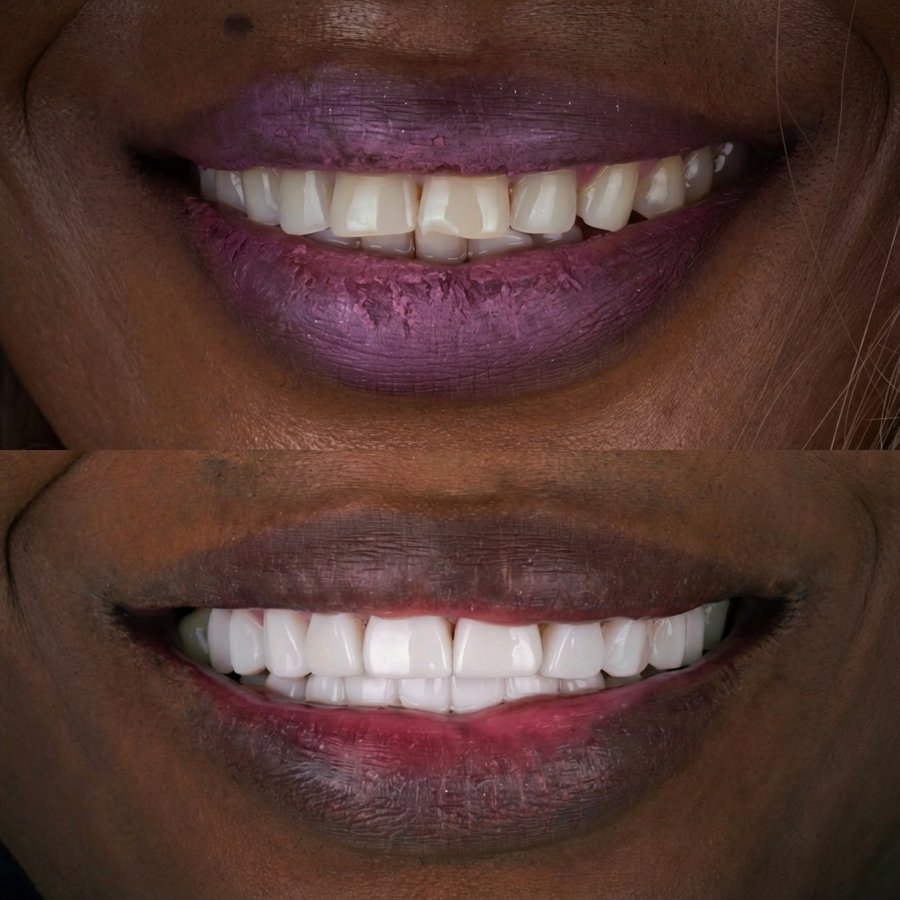 Smile design with Porcelain Veneers