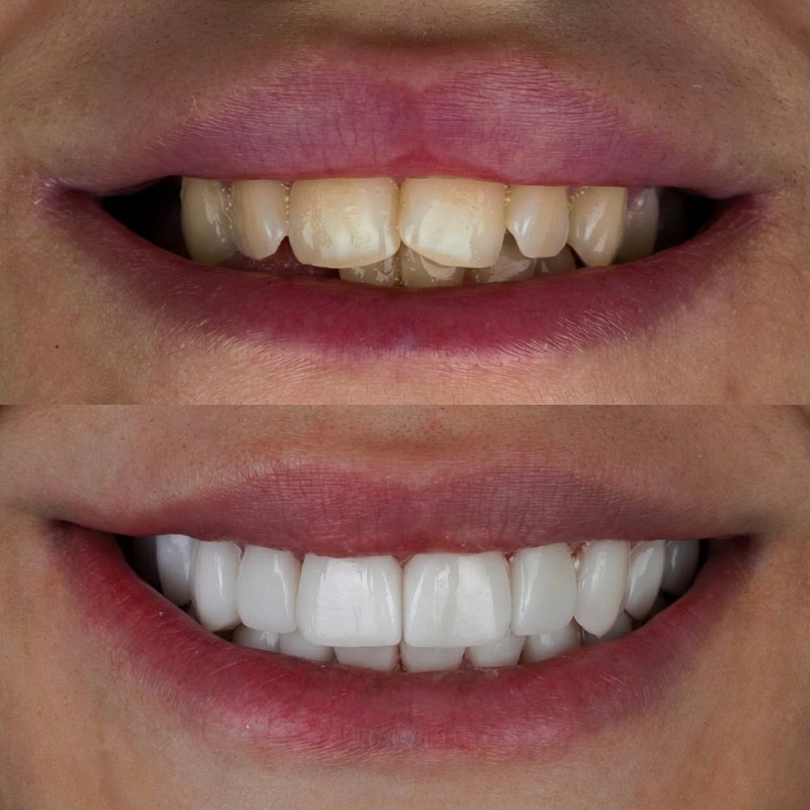 Smile design with Porcelain Veneers