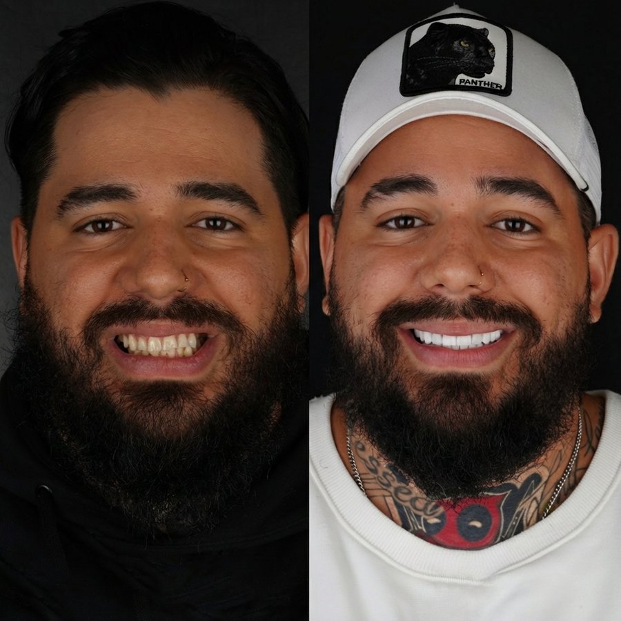 Smile design with Porcelain Veneers