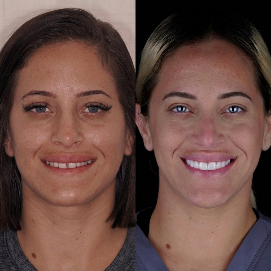 Smile design with Porcelain Veneers