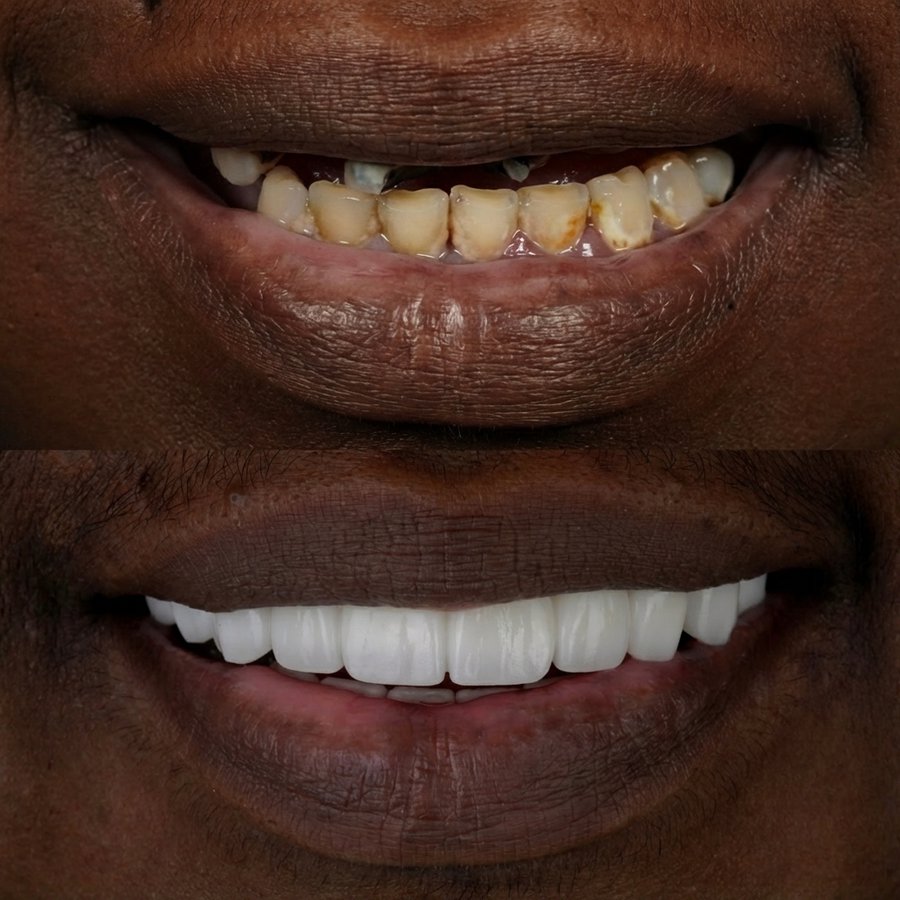 Hybrid Denture (top) and Porcelain Veneers (bottom)